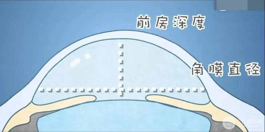 ICL晶体植入