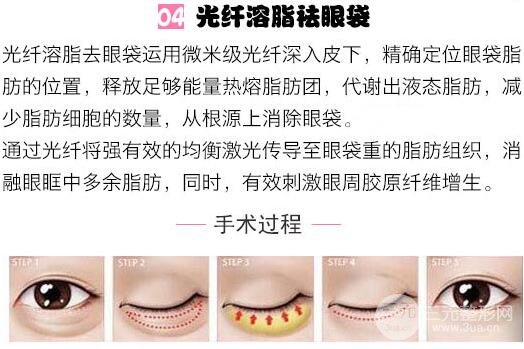 激光去眼袋