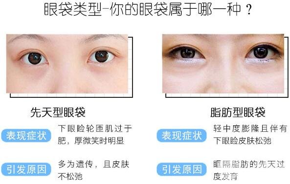 去眼袋小课堂：眼袋的类型