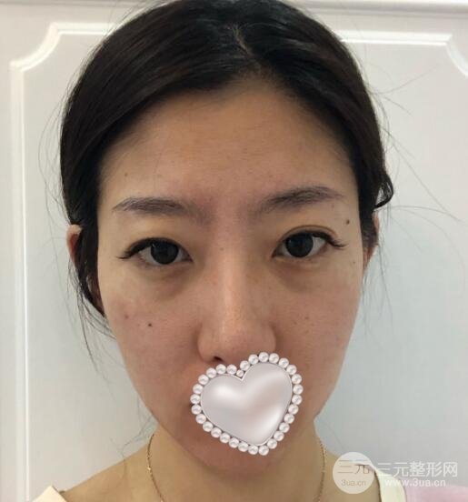 消除眼袋成功案例