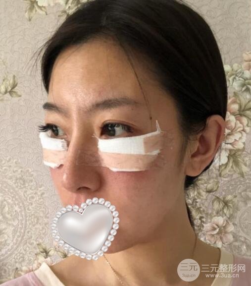 去眼袋术后