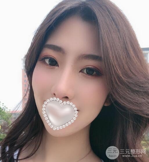去眼袋术后果图