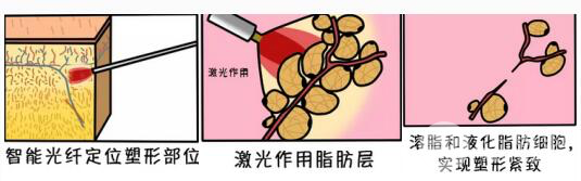 激光溶脂(也叫光纤溶脂)