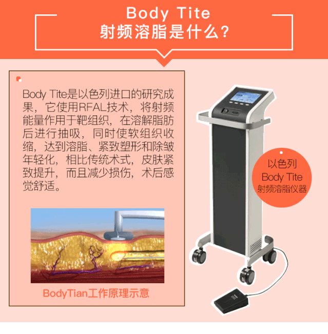 射频溶脂