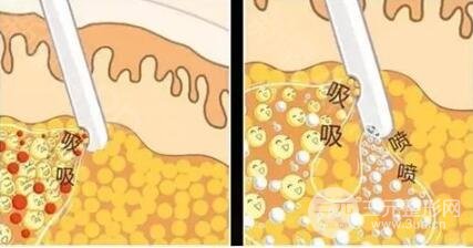 疼痛感较轻吸脂怎么做的?