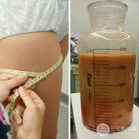 疼痛感较轻吸脂后痛吗?