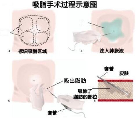 疼痛感较轻吸脂怎么做的?