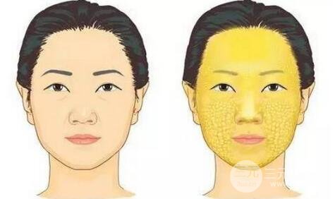 脂肪填充一年后面部凹陷的原因是什么?