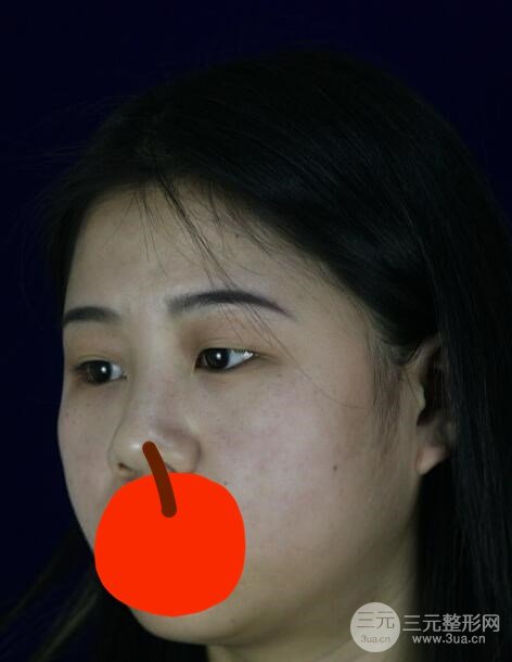 微创双眼皮术前