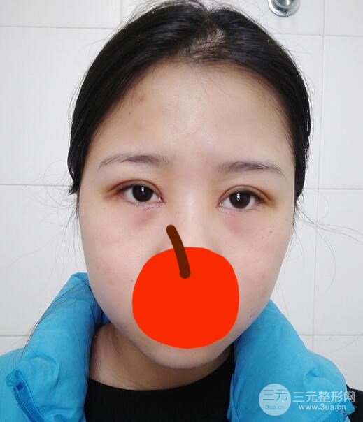 微创双眼皮术后第3天