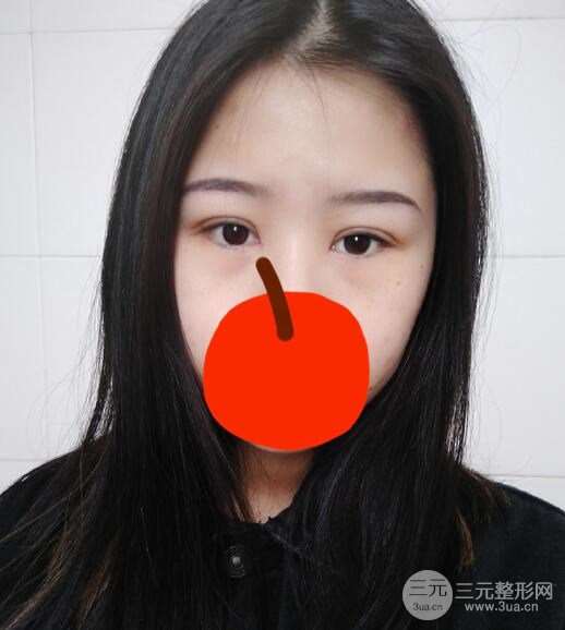 微创双眼皮术后第13天