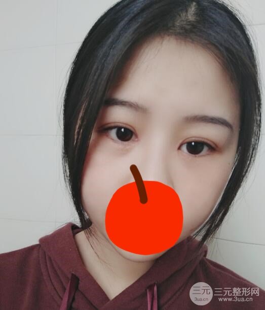 微创双眼皮术后第33天