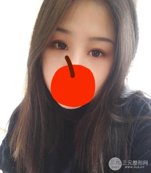 微创双眼皮术后第23天