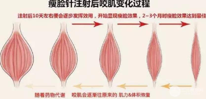 注射瘦脸注射后咬肌变化过程图