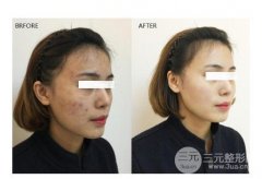 彩光嫩肤注意事项，三甲医院缓解经历