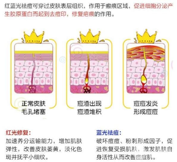 红蓝光祛痘