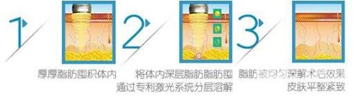 面部光纤溶脂后多久能够看到果?