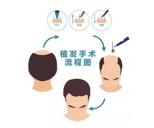 植发之后注意事项有哪些?