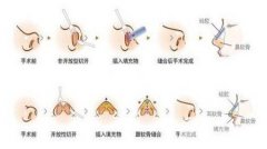 蒜头鼻整形多少钱?附蒜头鼻整形果前后对比 蒜头鼻整形多少钱?附蒜头鼻整形果前后对比