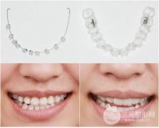 一个牙套多少钱?三甲医院牙套矫正价格及经历分享 一个牙套多少钱?三甲医院牙套矫正价格及经历分享