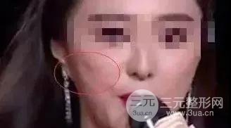 术后凹陷
