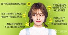 垫下巴多长时间恢复？超全科普3种垫下巴方法如何恢复较快！