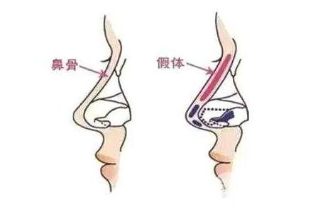 在做假体隆鼻时，我们应该注意什么?