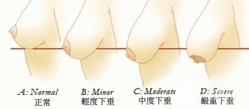 引起乳房下垂的因素有四点：