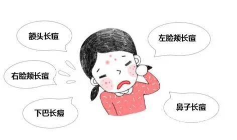 激光祛痘多少钱