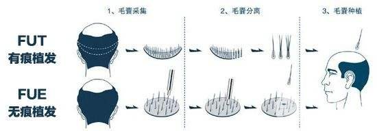 植发方式缓解脱发