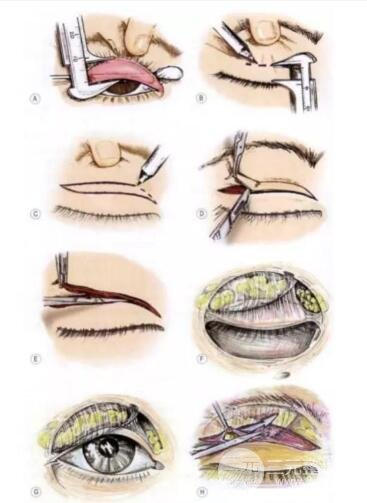 生物焊接双眼皮过程图|步骤图