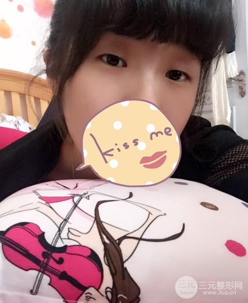 生物焊接双眼皮真人案例