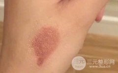 疤痕修复费用好便宜，后悔没早点去做!
