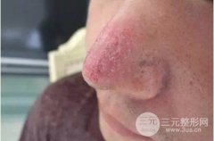 酒糟鼻整形术靠谱吗？放任不管会怎么样?