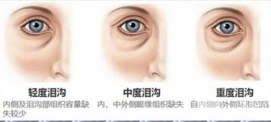 泪沟纹严重程度