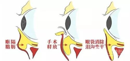 眶隔脂肪释放法填充泪沟纹
