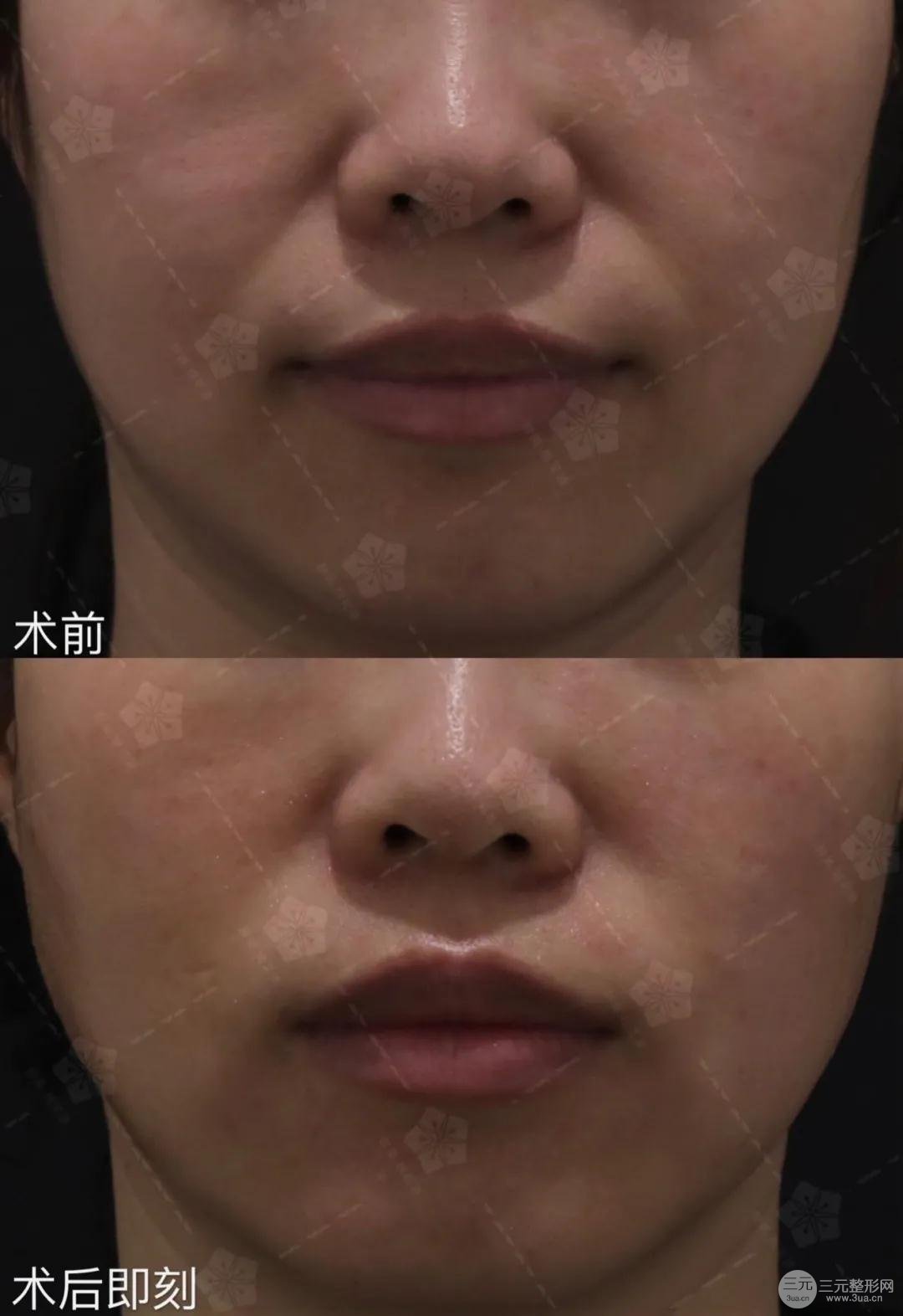热玛吉案例