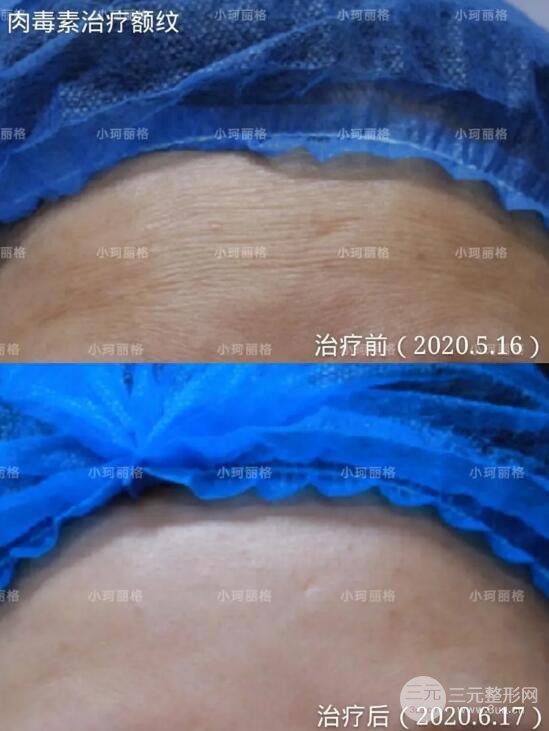rd素抗衰除皱