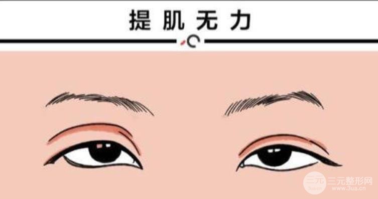双眼皮失败修复