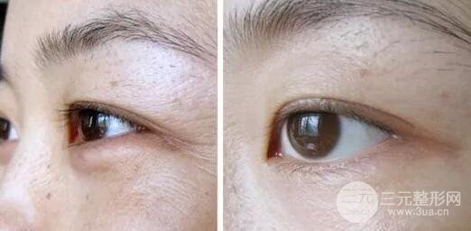 眼部热玛吉术后