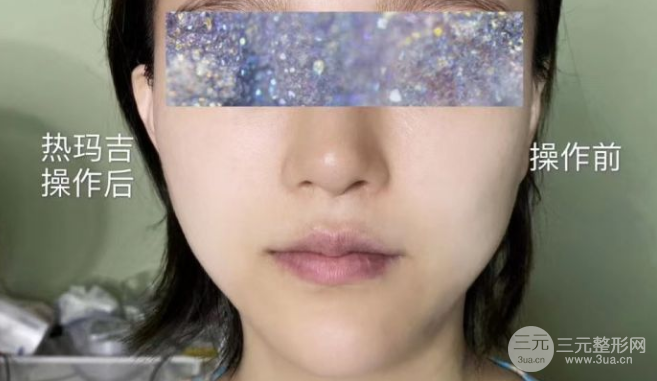 热玛吉紧肤除皱果图