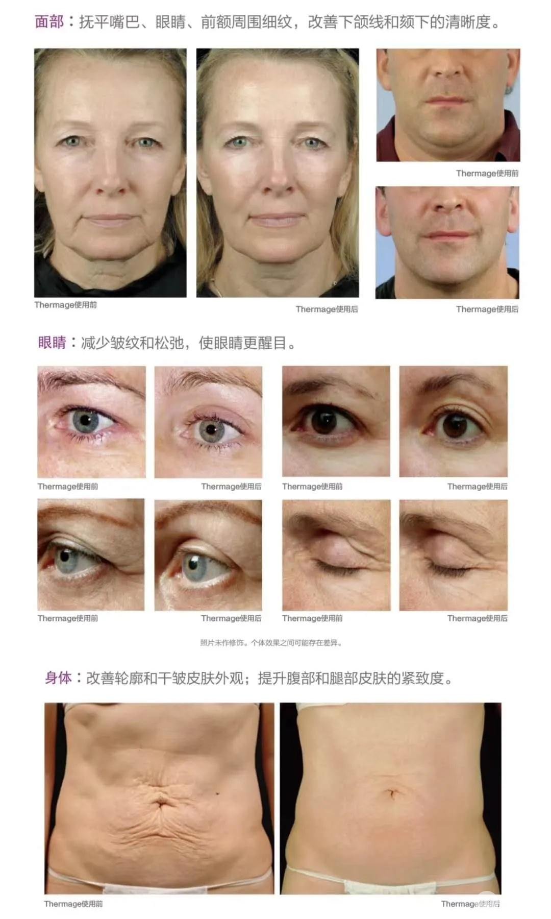 热玛注射瘦脸用范围