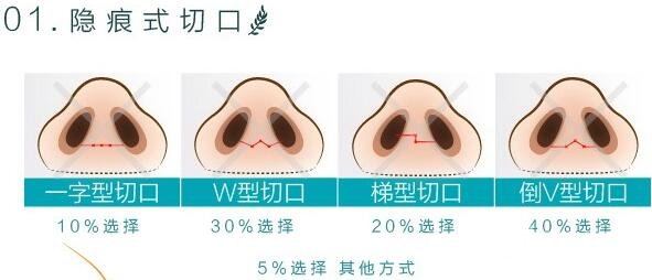 隆鼻切口