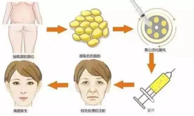 为什么要做脂肪填充?