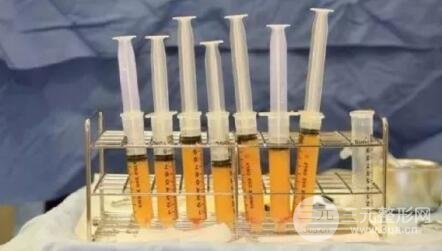 脂肪填充脸部的副作用有哪些?