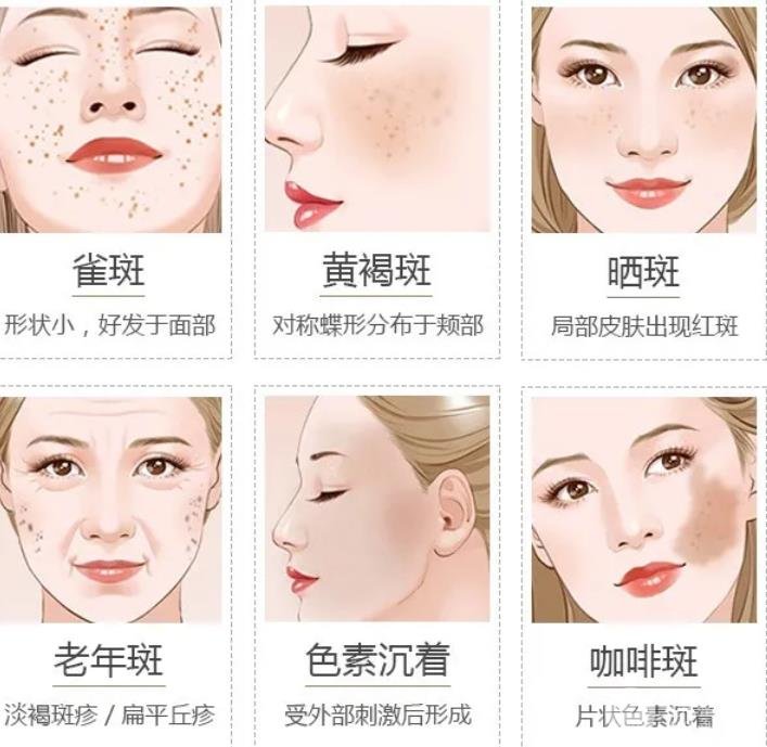 激光祛斑会反弹吗