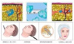 仪器减肥有果吗？如何选？哪种仪器更适合你？