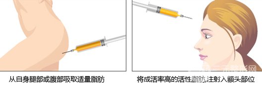 手术原理