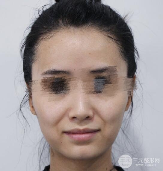 自体脂肪移植填充体验