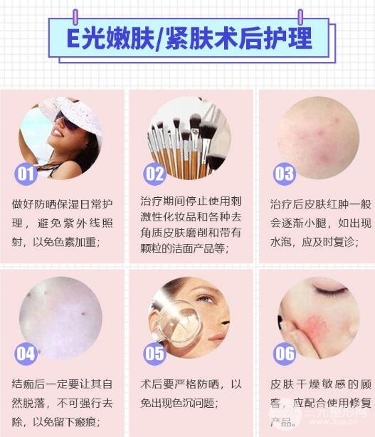 光子嫩肤后,会让皮肤变得敏感吗?我们应该注意哪些护理问题?
